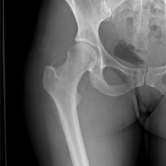 x-ray soft tissues thigh ap view